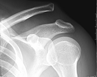 Luxación Acromioclavicular