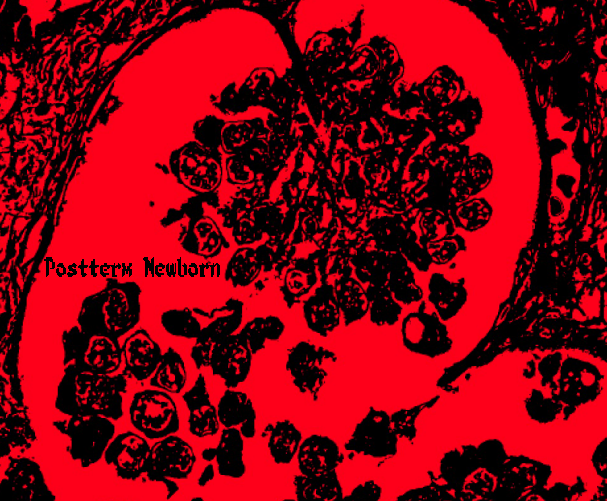 Cover image for Postterm Newborn