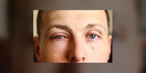 Cover image for INDAYIBLE - Pink eye treatment but rushed in one day