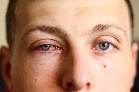 Cover image for INDAYIBLE - Pink eye treatment but rushed in one day