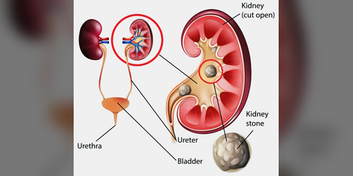 Cover image for kidney stone simulator